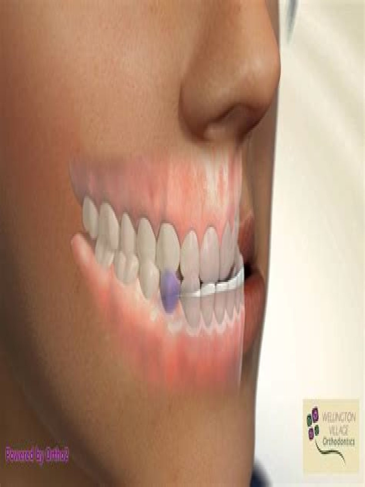 Can you remove premolars?