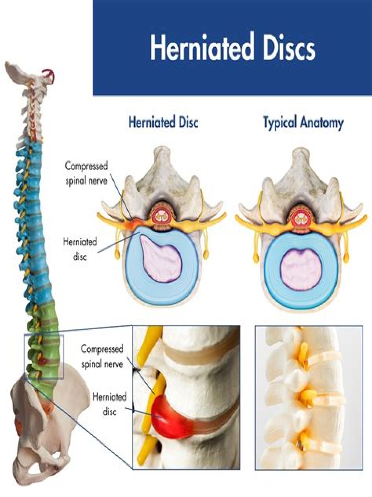 Is herniated disc painful?