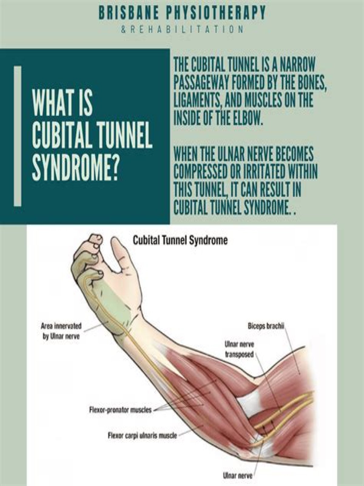 What are the symptoms of cubital tunnel syndrome?