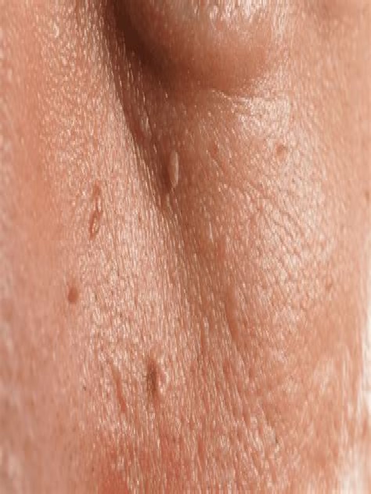 Why do skin tags just pop up?